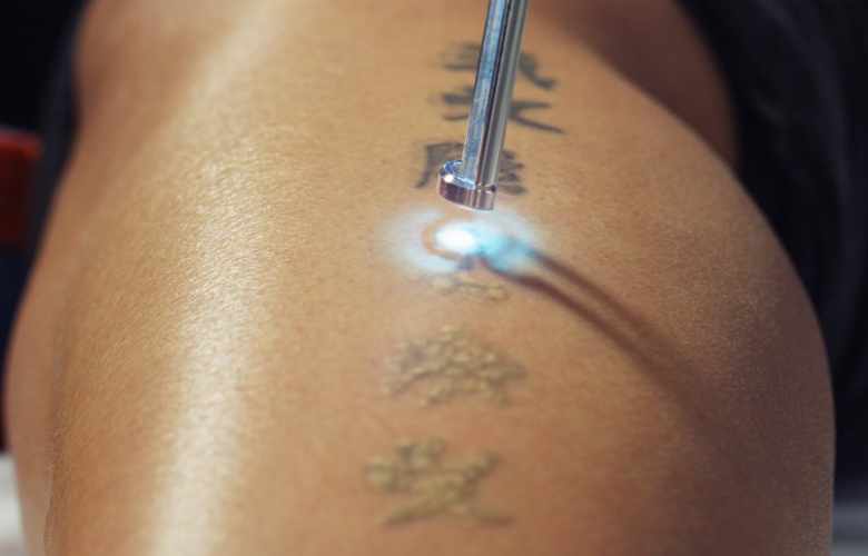 How does laser tattoo removal work