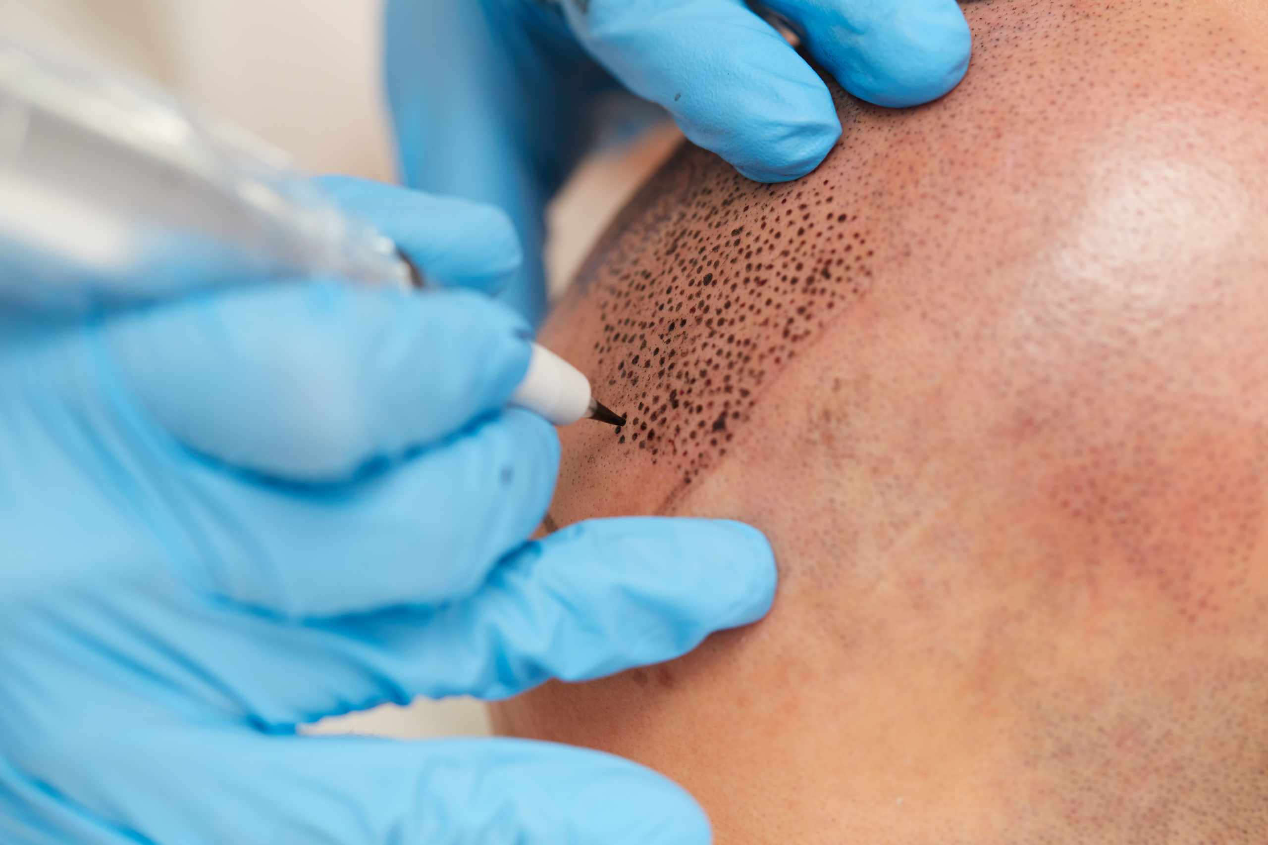 professional tattooist making permanent make up tricopigmentatio