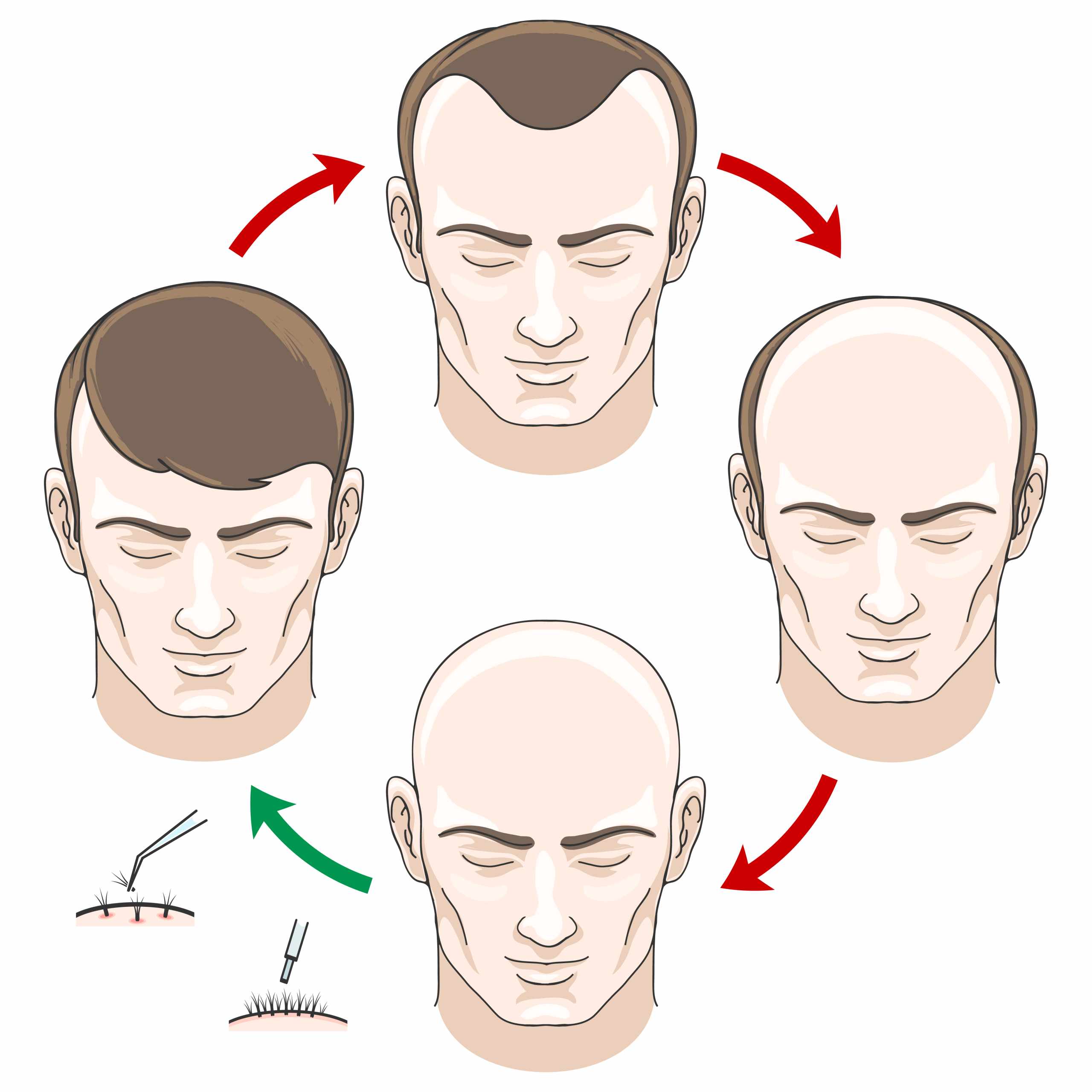Hair Transplant Guide