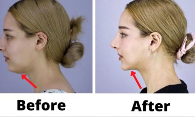 How You Can Reduce Your Chin fat dissolver