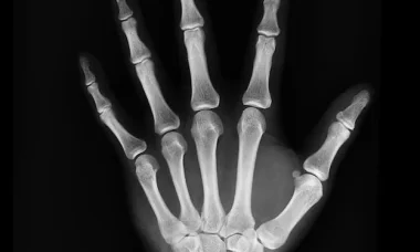 X-ray
