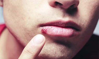 4 Remedies For Cold Sores