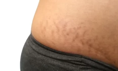 Stretch Marks