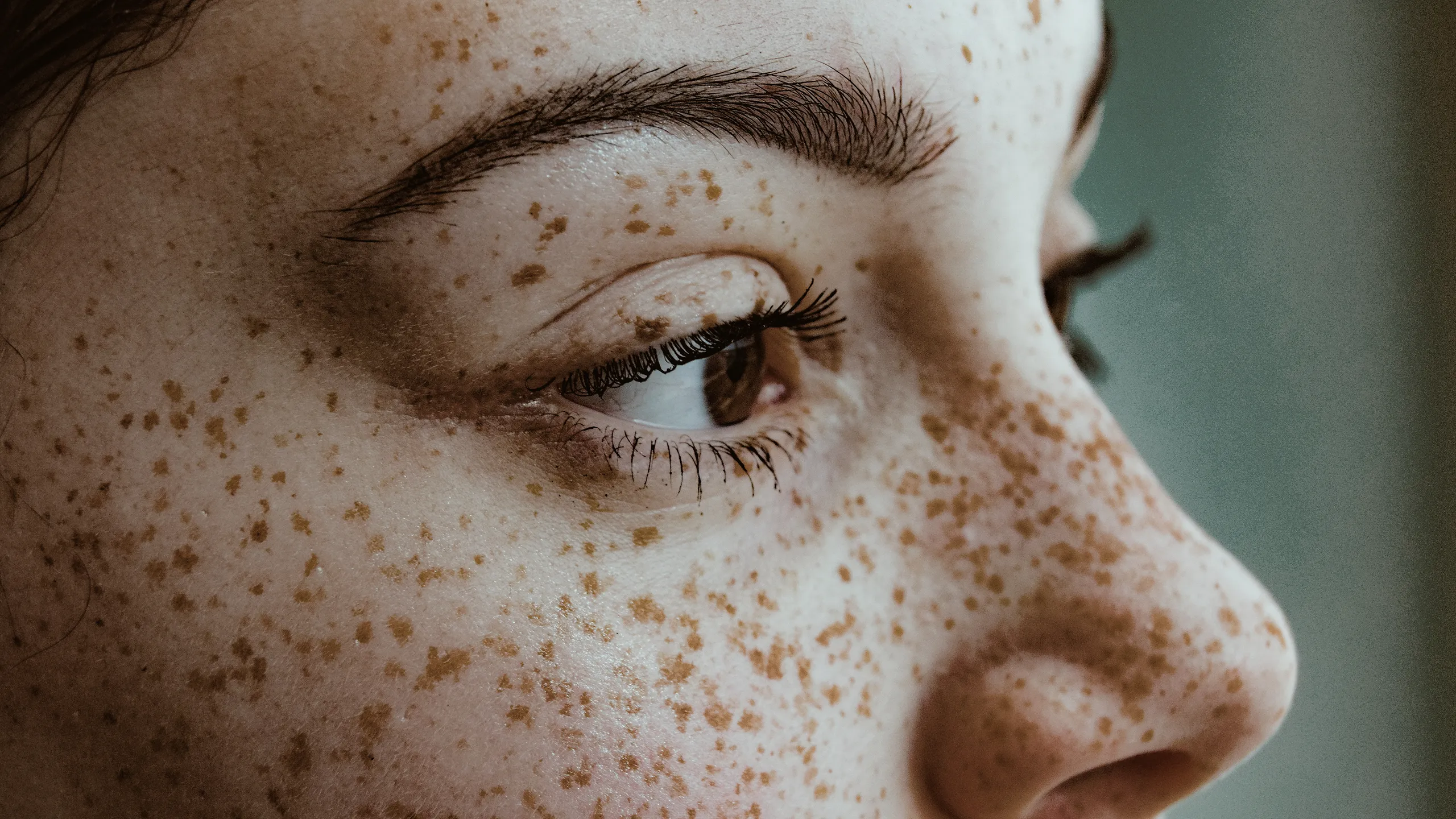 freckles on skin