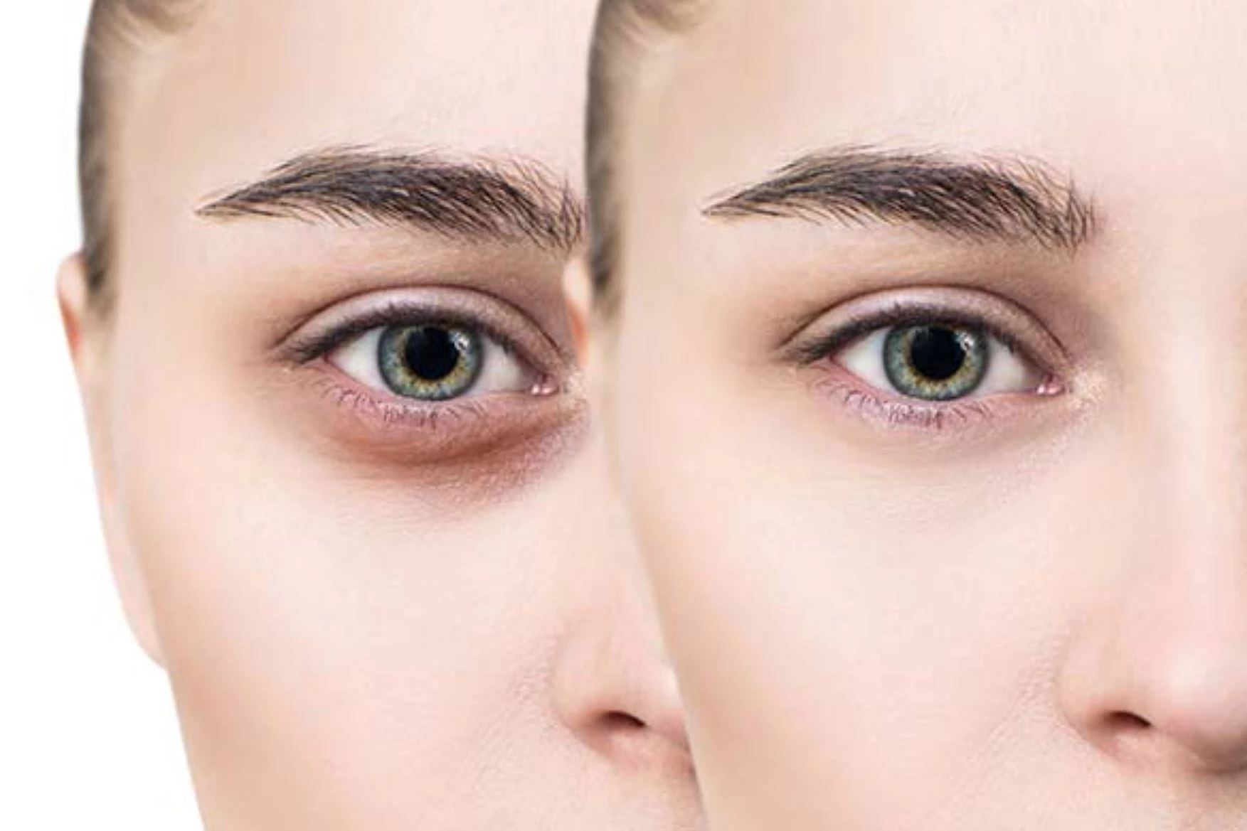 Tired of Looking Tired? Here's How Dark Eye Circle Treatment in