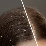 How to get rid of lice naturally in one day